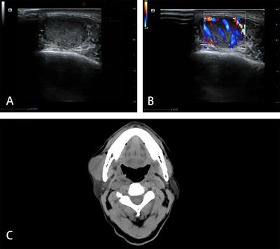 Masseter Muscle Metastasis of Renal Cell Carcinoma: A Case Report and Literature Review